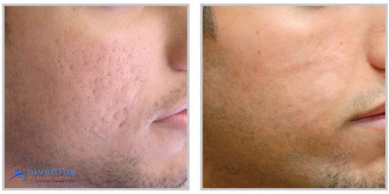 PRP Skin Rejuvenation Treatment – Benefits and Treatment